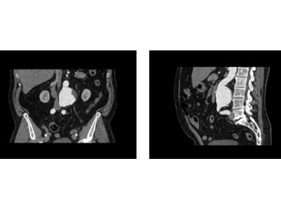 WEK53-05动脉瘤腹部模体 CT血管造影模型图2