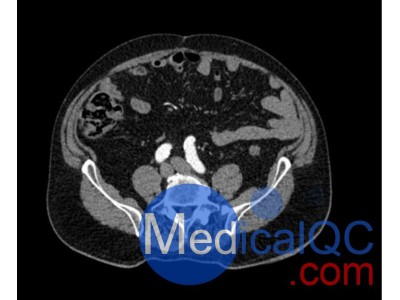 WEK53-05动脉瘤腹部模体 CT血管造影模型图3