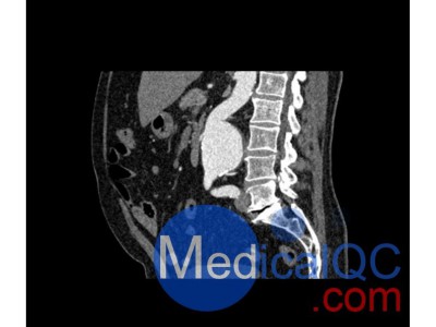 WEK53-05动脉瘤腹部模体 CT血管造影模型图4
